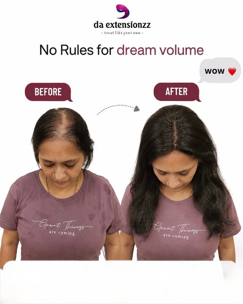 Before and after of a hair topper at DA Extensionzz, Chennai — a widening parting covered and blended into the client’s own hair