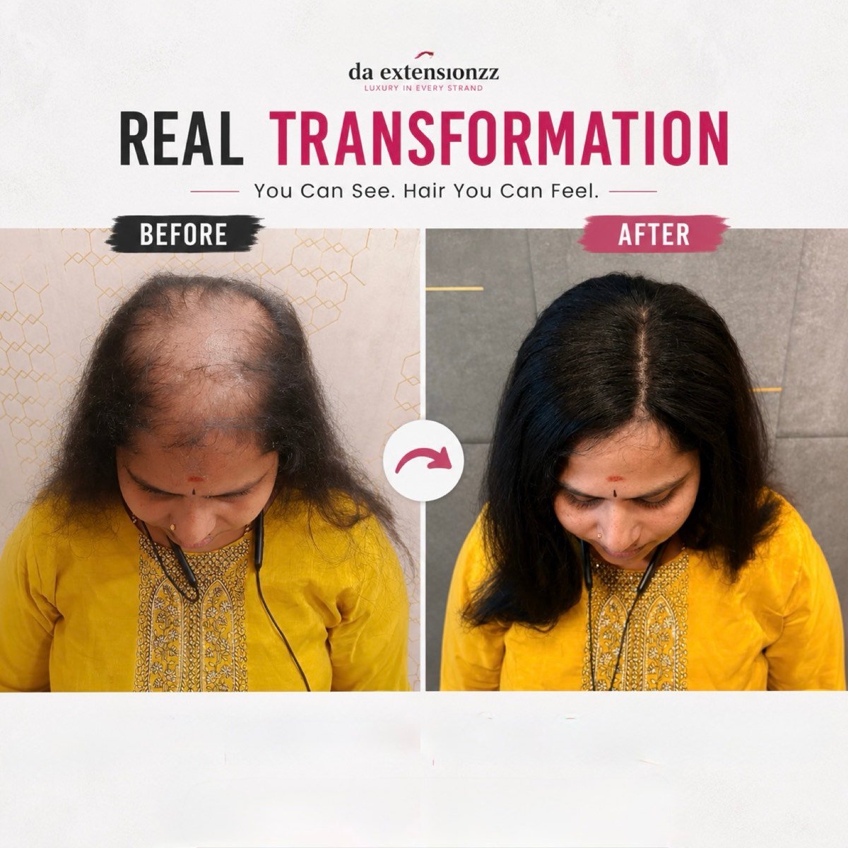 Before and after of a hair topper at DA Extensionzz Chennai — a widening parting covered and blended in