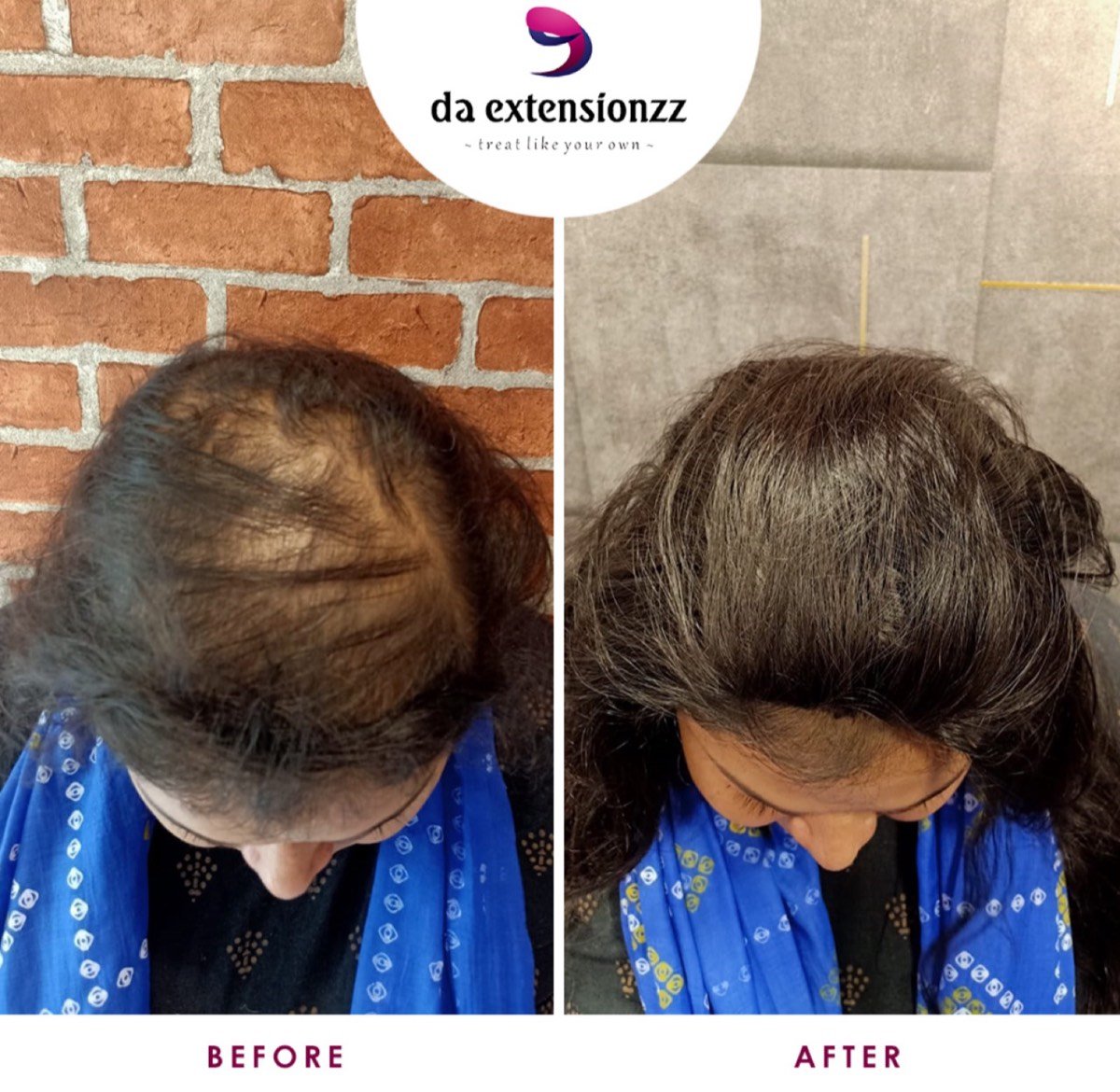 Before and after of a hair topper at DA Extensionzz Chennai — a widening parting covered and blended in