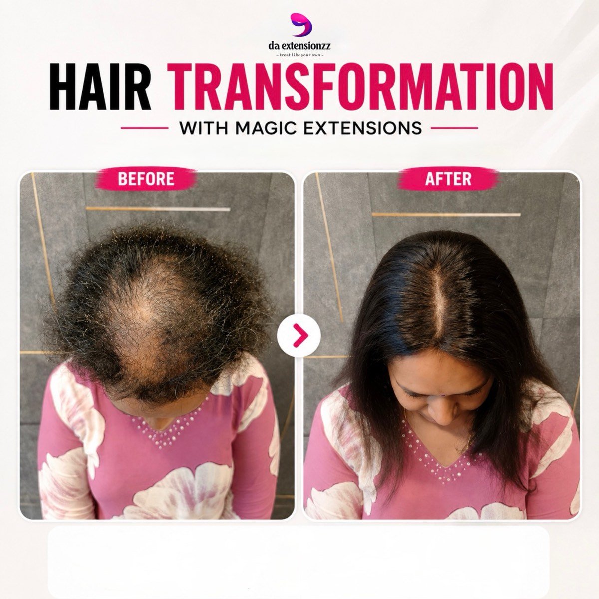 Before and after of a hair topper at DA Extensionzz, Chennai — a widening parting covered and blended into the client’s own hair