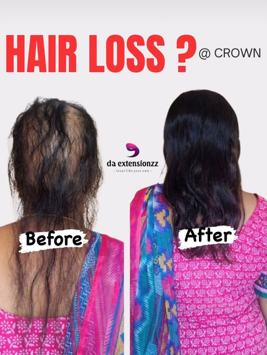 Before and after of added density at a thinning crown at DA Extensionzz, Chennai