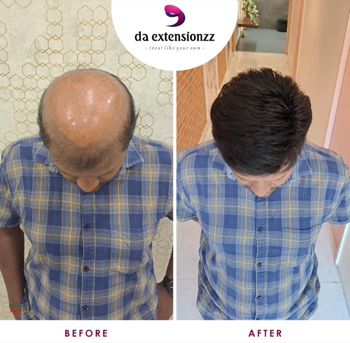 Before and after of a men’s hair system at DA Extensionzz, Chennai — thinning crown restored to full coverage