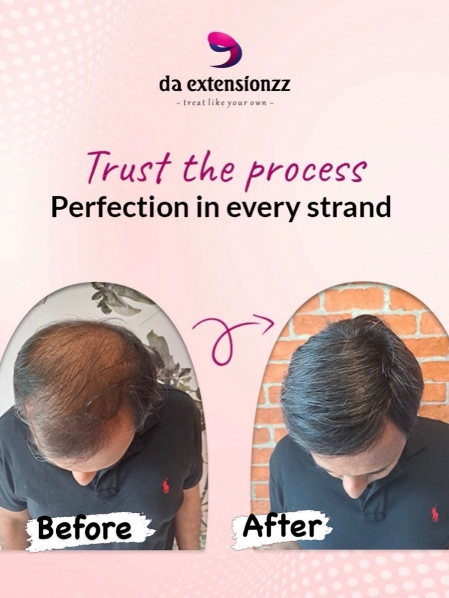 Before and after of a men’s hair system at DA Extensionzz Chennai — thinning crown restored to full coverage
